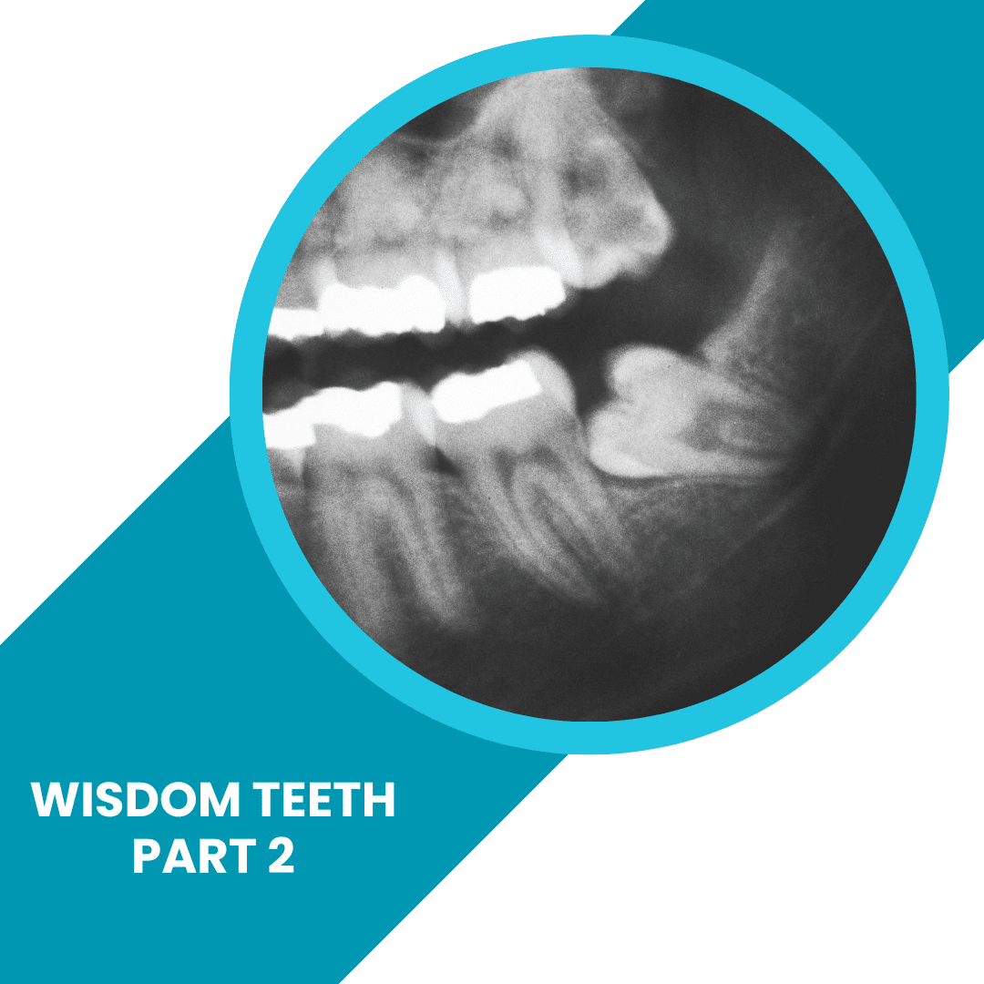 When do wisdom teeth start to appear?