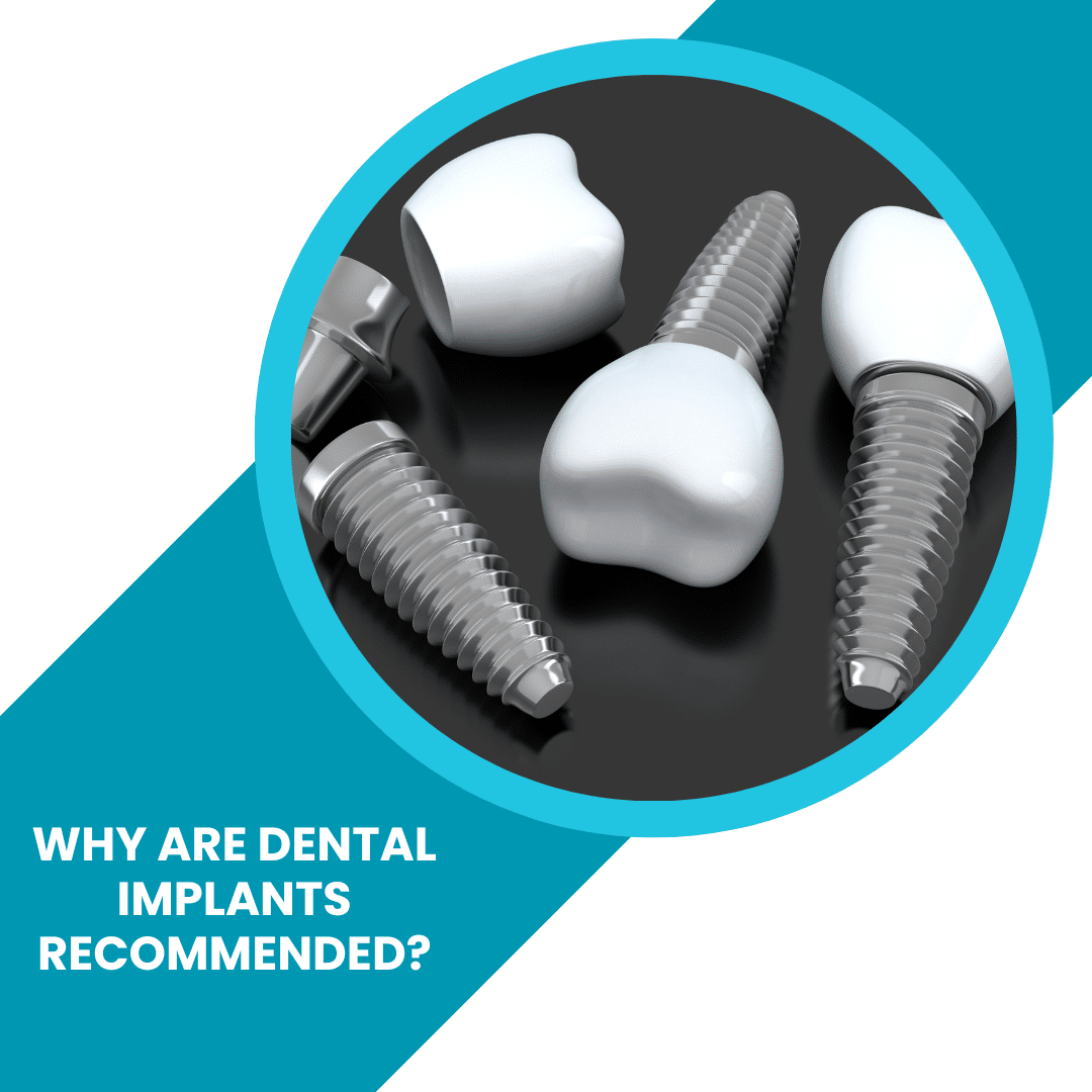 Why are Dental Implants Recommended? - Dental FAQs