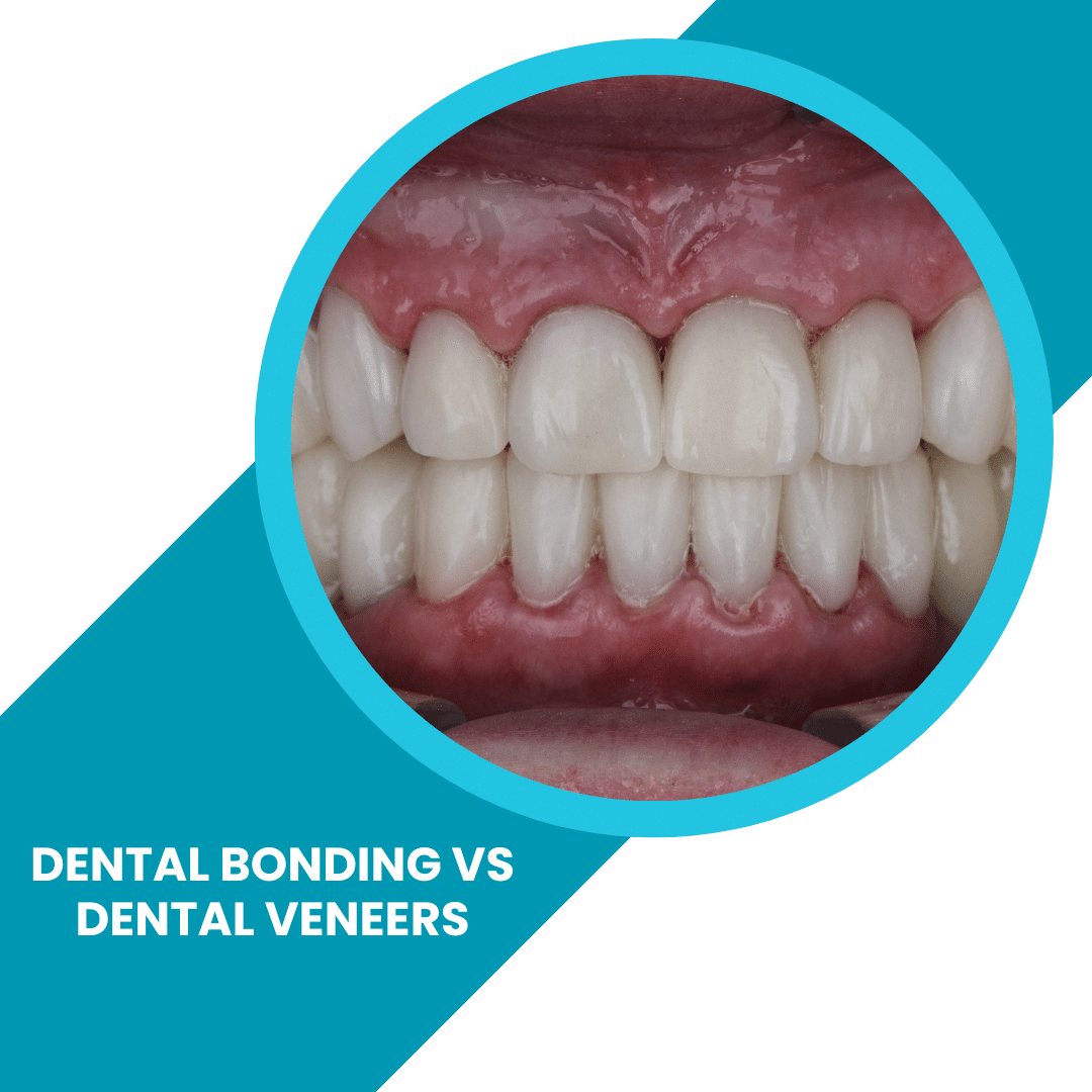 Dental Bonding vs. Dental Veneers - Which is Better for You? - ToothFeed