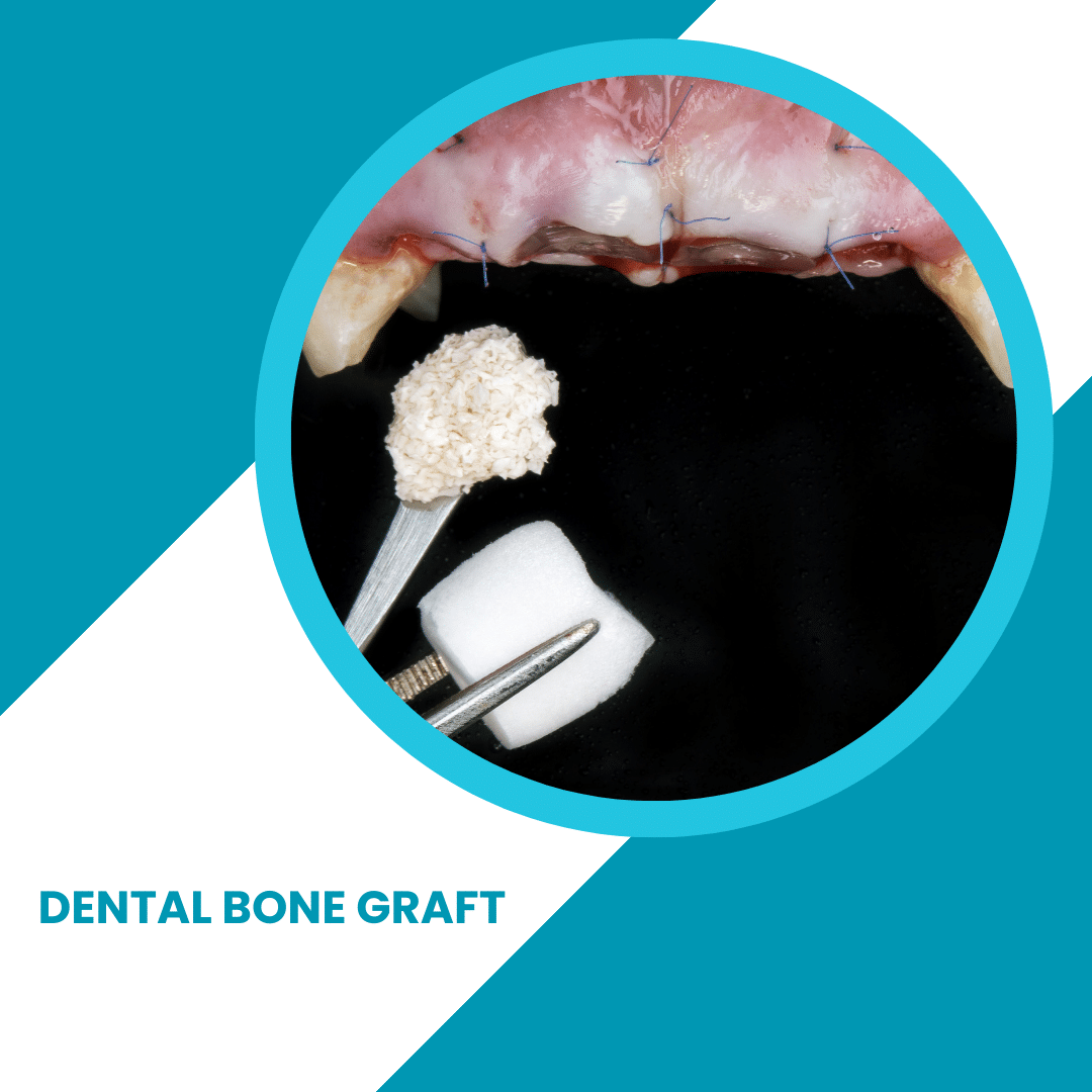Dental Bone Graft - Do you Need it? - ToothFeed