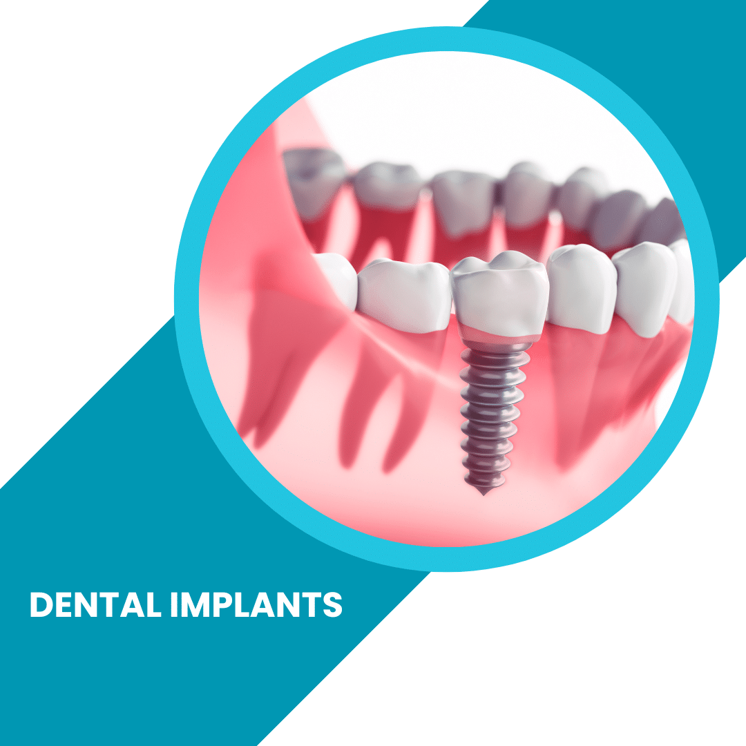 Dental Implants - Do You Need an Implant? - ToothFeed