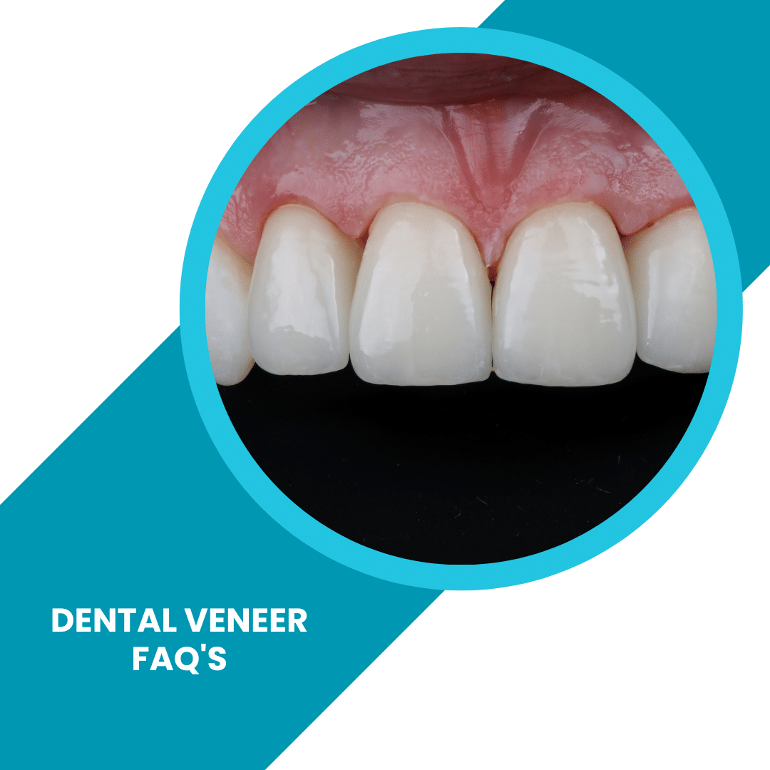 Dental Veneer FAQ's - How much do Veneers Cost?
