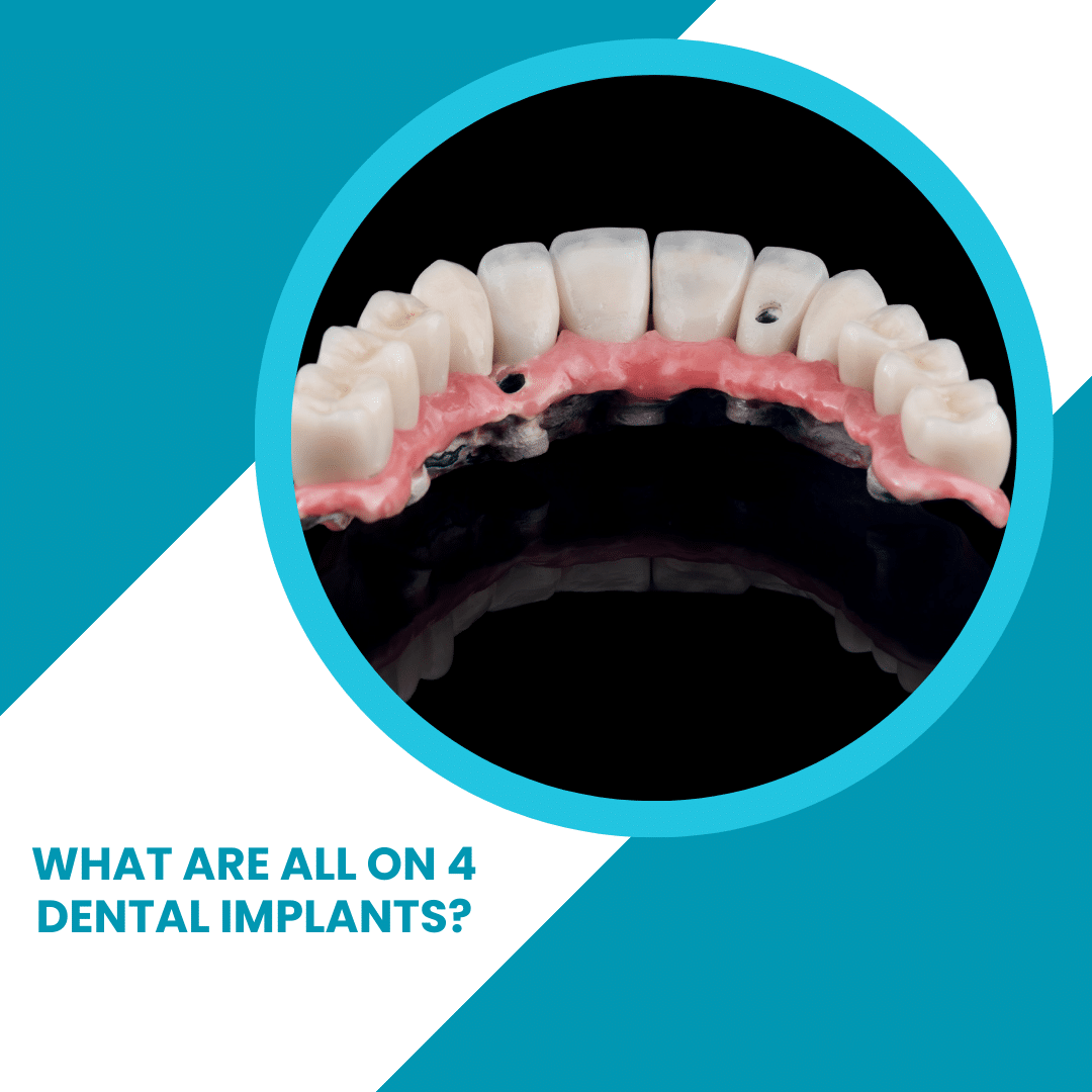 What are All on 4 Dental Implants - How Much Do Dental Implants Cost?