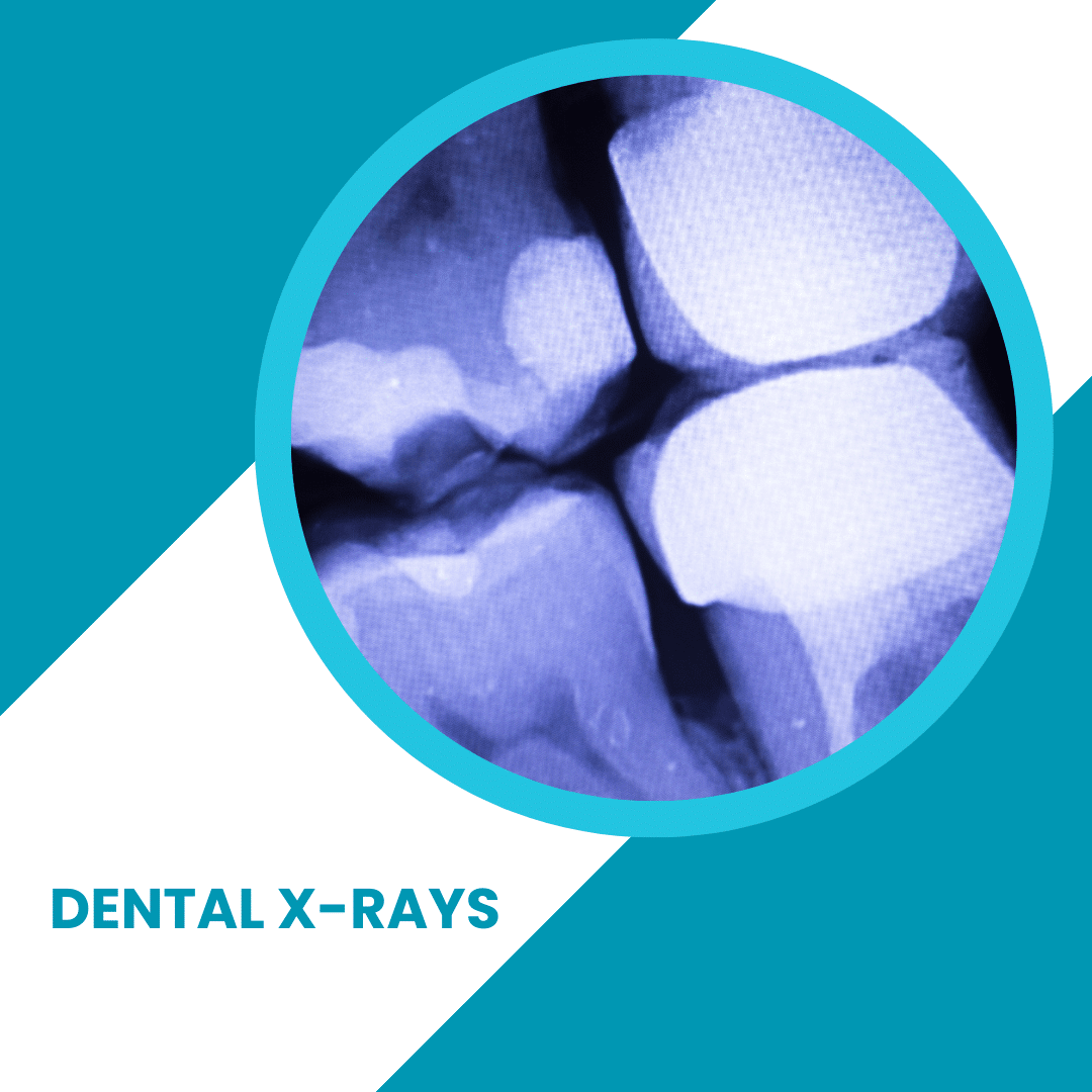 Dental X-rays - How much Radiation? - ToothFeed