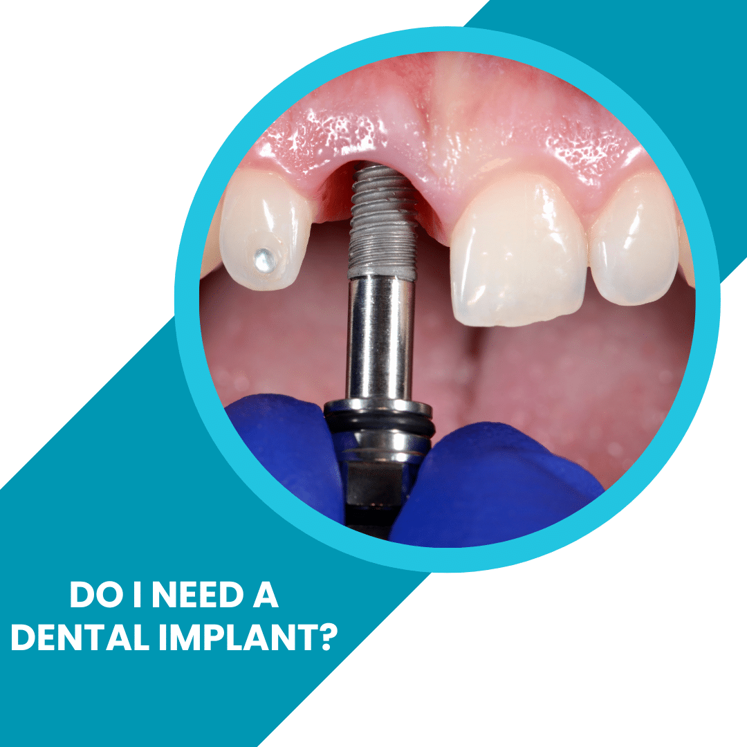 Do I Need a Dental Implant - ToothFeed