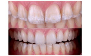 ICON Resin Infiltration Before and After - White Spots on Teeth